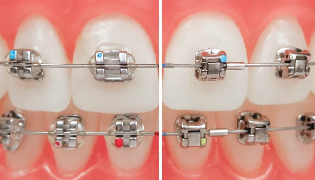 Czy aparat samoligaturujący jest lepszy? Odkryj jego wady i zalety